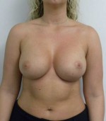 Breast Augmentation