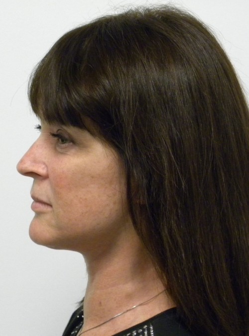 Facelift Case 8695 After Photo Facelift