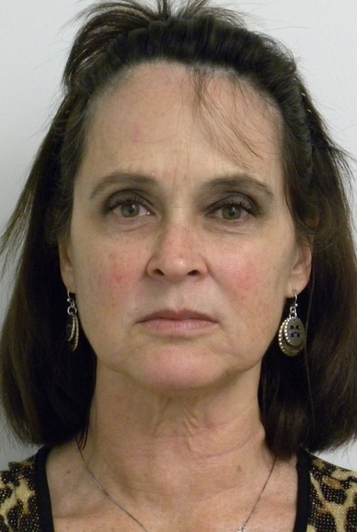 Facelift Case 8695 Before Photo Facelift
