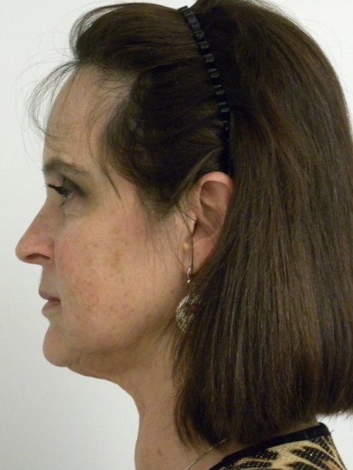 Neck Lift Case 8701 Before Photo Neck Lift