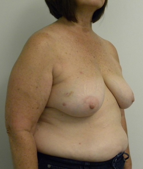 Breast Reconstruction