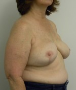 Breast Reconstruction