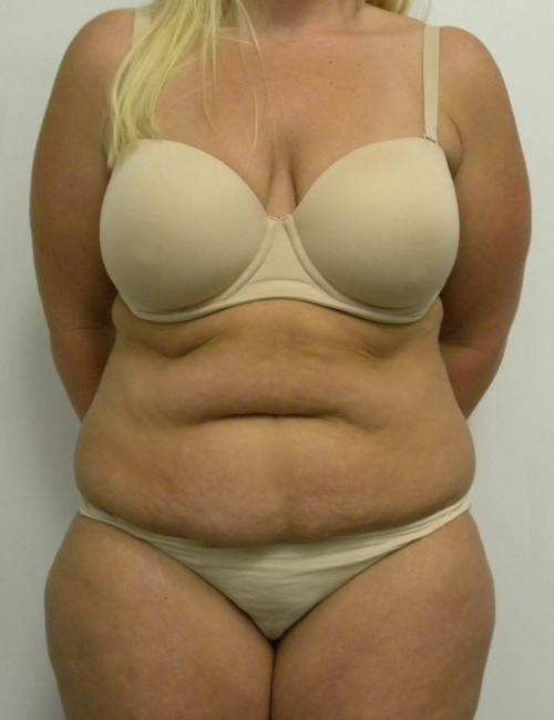 Tummy tuck (Abdominoplasty)