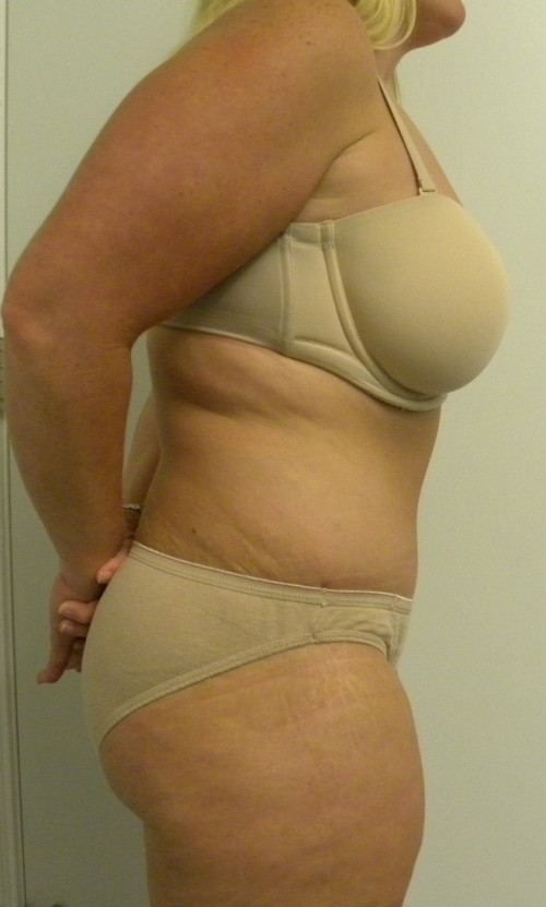 Tummy tuck (Abdominoplasty)