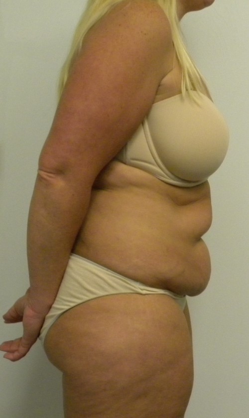 Tummy tuck (Abdominoplasty)