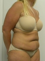 Tummy tuck (Abdominoplasty)