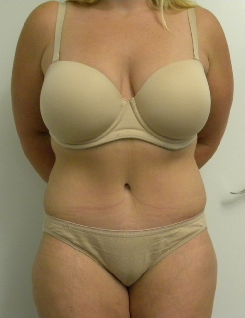 Tummy tuck (Abdominoplasty)