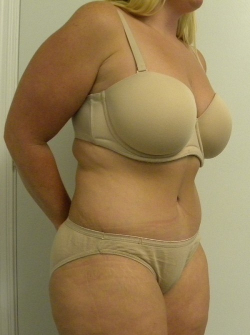 Tummy tuck (Abdominoplasty) Case 8715 After Photo Tummy tuck (Abdominoplasty)