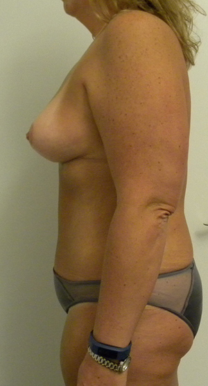 Mommy Makeover Case 8724 After Photo Mommy Makeover