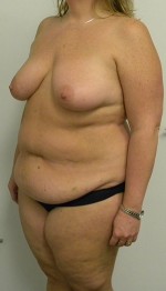 Mommy Makeover