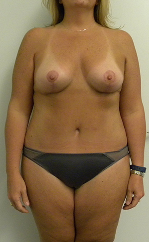 Mommy Makeover Case 8724 After Photo Mommy Makeover
