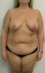 Mommy Makeover