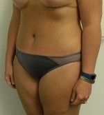 Tummy tuck (Abdominoplasty)