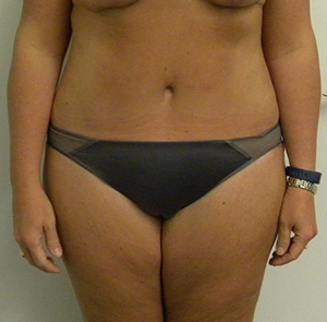 Tummy tuck (Abdominoplasty)