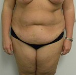 Tummy tuck (Abdominoplasty)