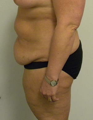 Tummy tuck (Abdominoplasty) Case 8732 Before Photo Tummy tuck (Abdominoplasty)