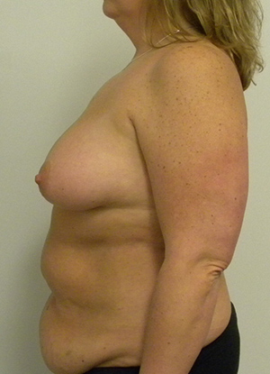 Breast Lift Case 8740 Before Photo Breast Lift