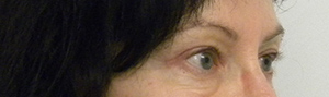 Eyelid Surgery Case 8748 After Photo Eyelid Surgery