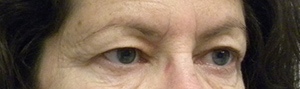 Eyelid Surgery Case 8748 Before Photo Eyelid Surgery