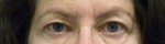 Eyelid Surgery