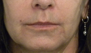 Valentine lip lift Case 8756 After Photo Valentine lip lift