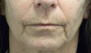 Valentine lip lift Case 8756 Before Photo Valentine lip lift