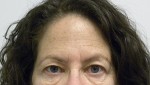 Brow Lift/Forehead Rejuvenation