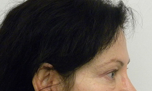 Brow Lift/Forehead Rejuvenation Case 8760 After Photo Brow Lift/Forehead Rejuvenation