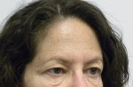 Brow Lift/Forehead Rejuvenation
