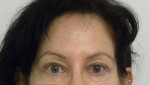 Brow Lift/Forehead Rejuvenation