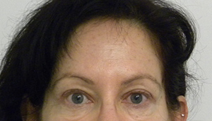 Brow Lift/Forehead Rejuvenation Case 8760 After Photo Brow Lift/Forehead Rejuvenation