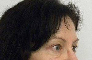Brow Lift/Forehead Rejuvenation Case 8760 After Photo Brow Lift/Forehead Rejuvenation