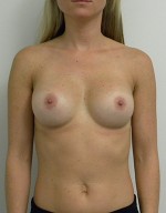 Breast Augmentation