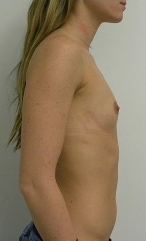 Breast Augmentation Case 8768 Before Photo Breast Augmentation