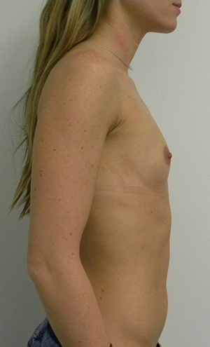 Breast Augmentation