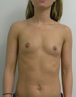 Breast Augmentation