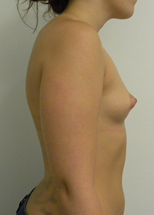 Breast Augmentation Case 8776 Before Photo Breast Augmentation