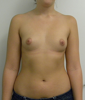 Breast Augmentation Case 8776 Before Photo Breast Augmentation