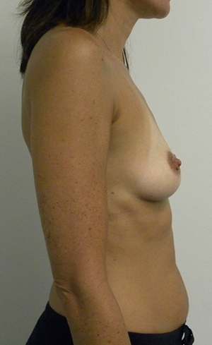 Breast Augmentation Case 8784 Before Photo Breast Augmentation