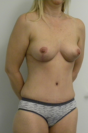 Mommy Makeover Case 8792 After Photo Mommy Makeover