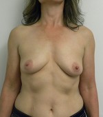 Breast Augmentation