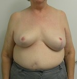 Breast Reduction