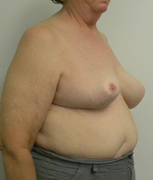 Breast Reduction Case 8840 After Photo Breast Reduction
