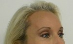 Brow Lift/Forehead Rejuvenation
