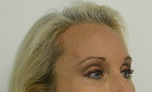 Brow Lift/Forehead Rejuvenation Case 8848 After Photo Brow Lift/Forehead Rejuvenation