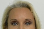 Brow Lift/Forehead Rejuvenation