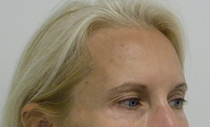 Brow Lift/Forehead Rejuvenation Case 8848 Before Photo Brow Lift/Forehead Rejuvenation