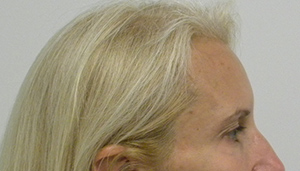 Brow Lift/Forehead Rejuvenation Case 8848 Before Photo Brow Lift/Forehead Rejuvenation