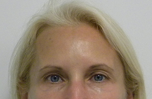Brow Lift/Forehead Rejuvenation Case 8848 Before Photo Brow Lift/Forehead Rejuvenation