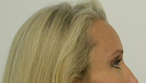 Brow Lift/Forehead Rejuvenation